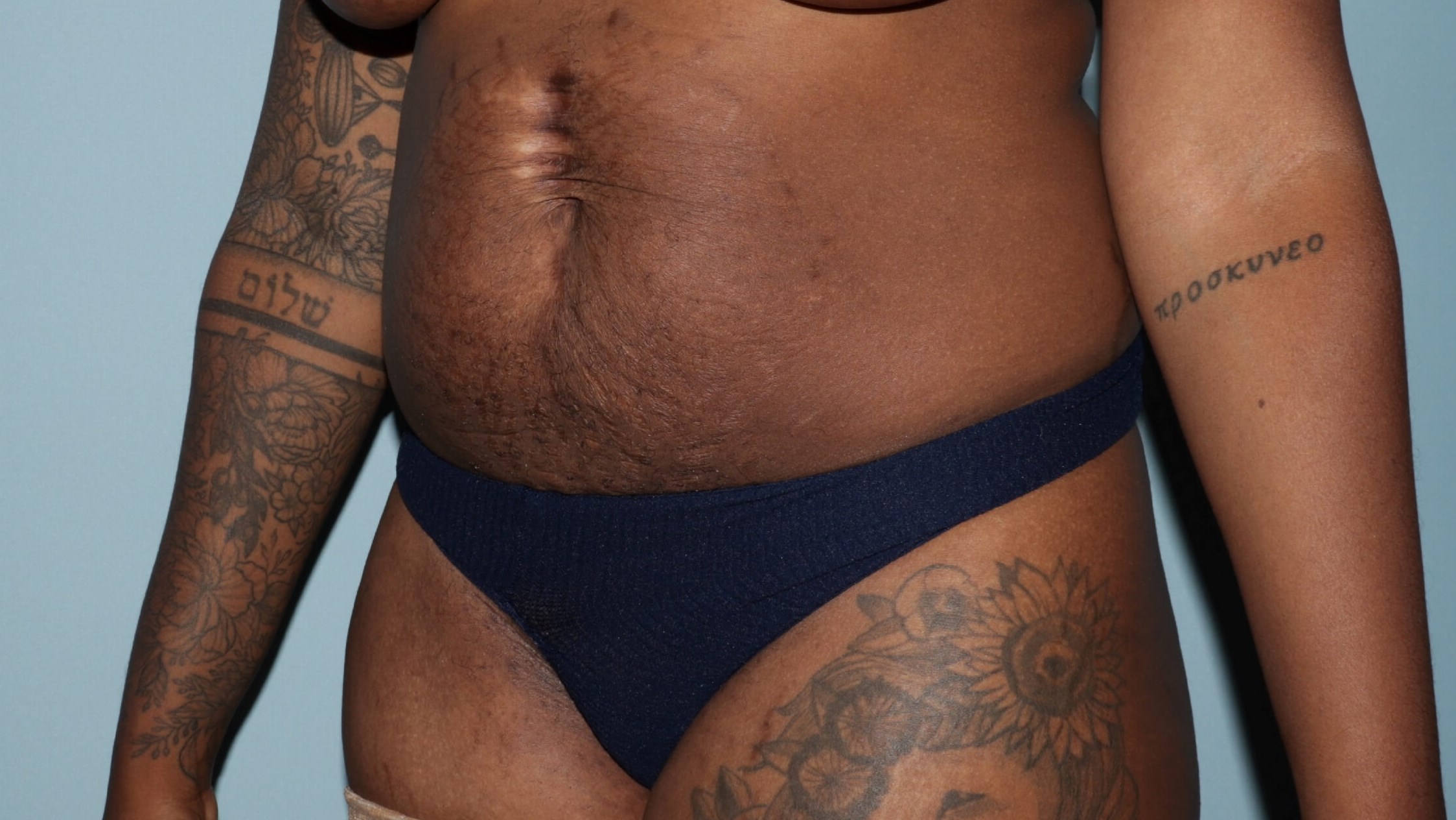 Pre-op oblique-Note depressed
